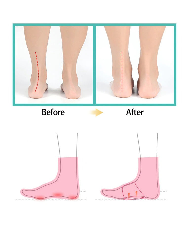Before and after comparison of Fitlybuy arch support insoles showing improved foot alignment and cushioning.