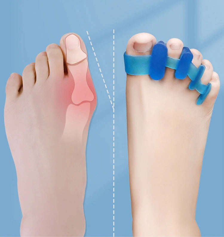 Fitlybuy blue silicone toe separator correcting a bunion on a human foot, showing alignment improvement.