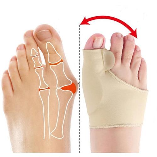 Fitlybuy orthopedic bunion corrector showing foot anatomy before and after wearing the beige fabric splint.