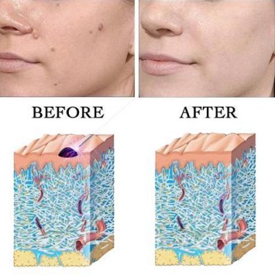 Fitlybuy Clear Skin Laser Pen showing before/after skin mole removal with a cross-section diagram of skin renewal.