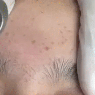 Fitlybuy Clear Skin Laser Pen treating skin spots on the forehead with advanced light-based renewal technology.