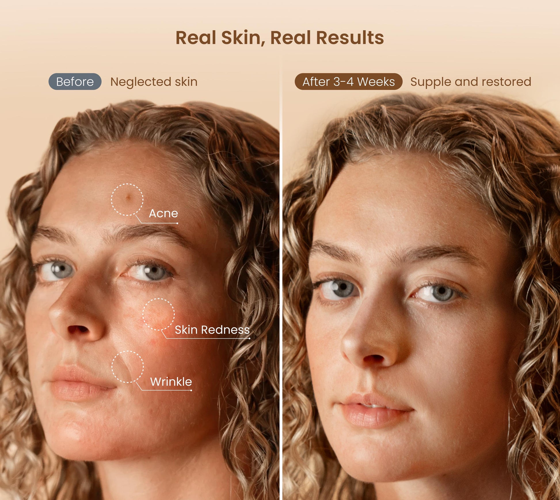 Fitlybuy Artemis LED mask before-and-after comparison showing reduced acne, redness, and wrinkles for clearer skin.